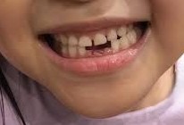 乳歯が抜けた子どもの口元の写真