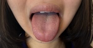 著者の娘のあいうべ体操の一コマの写真