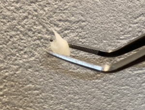 歯科医院で抜いた歯の写真。歯の根っこが一部残っていたので自然に抜けてこなかった