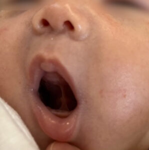 生まれて間もない乳児の口元の写真。舌が上に挙がっているのがよくわかる写真です。