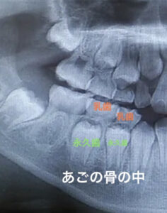 子どもの生え変わりの時期の顎の骨のレントゲンの写真。乳歯のしたに永久歯が生えてくる準備をしているのが分かりやすくなっています。