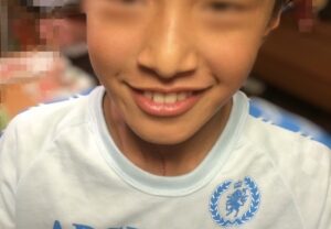 著者の次男の小学生の頃の口元の写真。我が家の子ども達は虫歯ゼロです。
