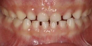 乳歯の歯並びは、永久歯の準備のためすき間があいている方がいいです。乳歯の理想的な歯並びの写真