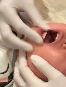 はじめての経験で嫌がりながらもお口のマッサージを受けている赤ちゃんの口元の写真